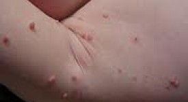 Ejercicios para la celulitis. Ejercicios para combatir celulitis