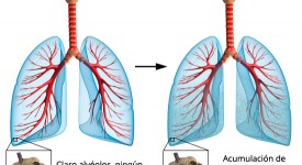 Sinusitis | Causas, tratamiento e informaciÃ³n sobre la sinusitis