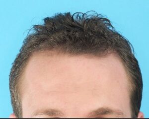 Causas y tratamientos de la alopecia androgénica
