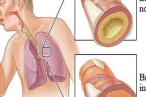 Gripe | Causas, tratamiento, contagio y mÃ¡s informaciÃ³n